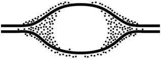 <strong> Grains represent radioactive material within the replicating eye. In an experiment,DNA is allowed to replicate in an environment with all necessary enzymes,dATP,dCTP,dGTP,and radioactively labeled dTTP (³H thymidine)for several minutes and then switched to nonradioactive medium.It is then viewed by electron microscopy and autoradiography.The figure above represents the results. Which of the following is the most likely interpretation?</strong> A)There are two replication forks going in opposite directions. B)Thymidine is only being added where the DNA strands are furthest apart. C)Thymidine is only added at the very beginning of replication. D)Replication proceeds in one direction only. E)Thymidine is not being incorporated into the DNA, but is associating with the DNA due to hydrogen bonding.