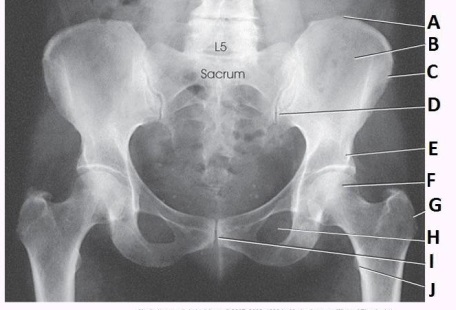 <strong>What anatomy is labeled as letter C in the image below? </strong> A) Iliac crest B) Ala of ilium C) ASIS D) AIIS