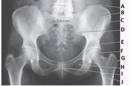 <strong>What anatomy is labeled as letter H in the image below? </strong> A) Pubic symphysis B) Obturator foramen C) Ischial tuberosity D) Superior pubic ramus