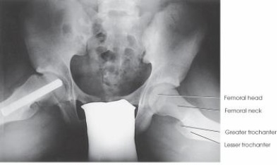 <strong>What projection and anatomy of interest is depicted in the image below? </strong> A) AP oblique (modified Cleaves); femoral necks B) AP oblique (Cleaves); femoral necks C) AP axial (Taylor); anterior pelvic bones D) AP axial (Bridgeman); pelvic inlet