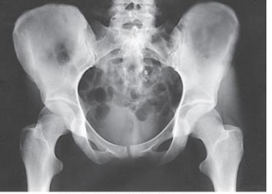 <strong>What positioning error is evident in the image below? </strong> A) None. This image meets all evaluation criteria for this projection. B) The lower limbs were not internally rotated. C) The lower limbs were not externally rotated. D) The knees were not flexed to reduce lordotic curve.