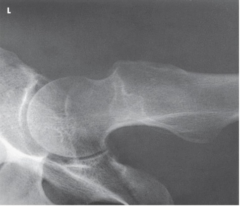 <strong>What projection (method) is demonstrated in the image below? </strong> A) AP oblique (modified Cleaves) B) Mediolateral (Lauenstein) C) Axiolateral (Danelius-Miller) D) AP oblique (Judet)