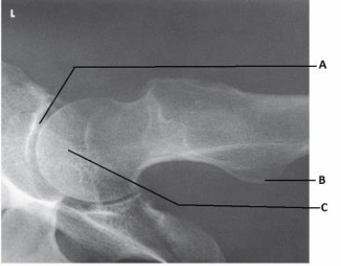 <strong>What anatomy is labeled as letter A in the image below? </strong> A) Acetabulum B) Femoral head C) Femoral neck D) Greater trochanter