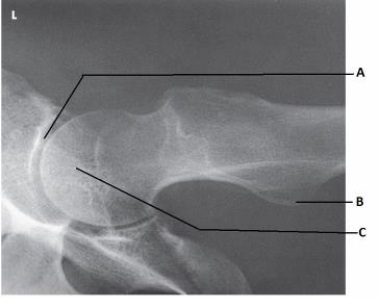 <strong>What anatomy is labeled as letter B in the image below? </strong> A) Acetabulum B) Femoral head C) Lesser trochanter D) Iliac crest