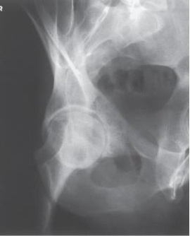 <strong>Examine this AP oblique (Judet) image of the right hip obtained with the patient positioned for the internal oblique. What patient position is depicted? </strong> A) 45 degrees RPO B) 45 degrees LPO C) 45 degrees RAO D) 45 degrees LAO