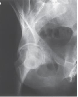 <strong>Examine this AP oblique (Judet) image of the right hip obtained with the patient positioned for the internal oblique. What is the anatomy of interest? </strong> A) Anterior acetabular rim and iliopubic column B) Posterior acetabular rim and iliopubic column C) Anterior acetabular rim and ilioischial column D) Posterior acetabular rim and ilioischial column