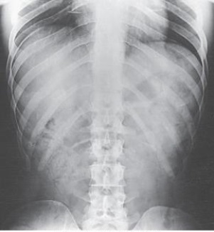<strong>Which ribs are best demonstrated in this image? </strong> A) Axillary portion of the right ribs B) Axillary portion of the left ribs C) Ribs above the diaphragm (upper ribs) D) Ribs below the diaphragm (lower ribs)