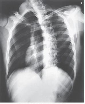 <strong>Which ribs are best demonstrated in the image below? </strong> A) Axillary portion of right ribs B) Axillary portion of left ribs C) Left ribs above the diaphragm D) Right ribs below the diaphragm