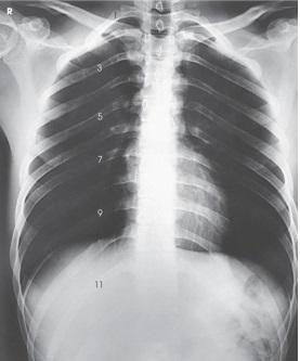 <strong>Which ribs are best demonstrated in the image below? </strong> A) Axillary portion of right ribs B) Axillary portion of left ribs C) Ribs above the diaphragm D) Ribs below the diaphragm