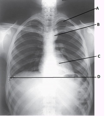 <strong>What anatomy is labeled as letter A in the image below? </strong> A) Apex of right lung B) Apex of left lung C) Costophrenic angle of right lung D) Costophrenic angle of left lung