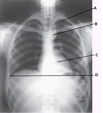 <strong>What anatomy is labeled as letter D and outlined with white dots in the image below? </strong> A) Apex of right lung B) Apex of left lung C) Costophrenic angle of right lung D) Costophrenic angle of left lung