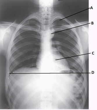 <strong>What anatomy is labeled as letter B in the image below? </strong> A) Apex of right lung B) Apex of left lung C) Aortic arch D) Thymus gland