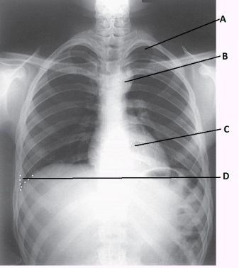 <strong>What anatomy is labeled as letter C in the image below? </strong> A) Thymus gland B) Heart C) Lingula D) Aortic arch