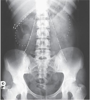 <strong>Which structures are outlined with dots in this AP image of the abdomen? </strong> A) Stomach B) Liver C) Kidneys D) Psoas muscles