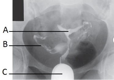 <strong>What reproductive system procedure is demonstrated in the image below? </strong> A) Hysterosalpingogram B) Vaginography C) Vesiculography D) Pelvimetry