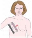 <strong>The projection of the breast shown in the figure below is a: </strong> A) mediolateral (ML). B) lateromedial (LM). C) mediolateral oblique (MLO). D) lateromedial oblique (LMO).