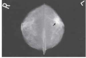 <strong>Examine the images below. Which mammographic projections are demonstrated? </strong> A) Craniocaudal B) Caudocranial C) Mediolateral oblique D) Lateromedial