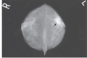 <strong>The arrow in the images below points to a mass with the characteristics of a: </strong> A) benign tumor. B) malignant tumor. C) fibrous tissue mass. D) cystic lesion.