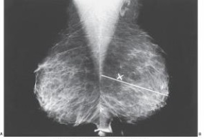 <strong>What projection is demonstrated in the images below? </strong> A) Craniocaudal B) Exaggerated craniocaudal C) Mediolateral oblique D) Lateromedial