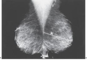 <strong>The white line, labeled as X in the images below is the _____ line. </strong> A) posterior nipple B) pectoralis muscle C) breast width D) breast length