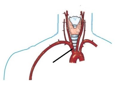 <strong>The artery identified in the figure below is the: </strong> A) brachiocephalic. B) left subclavian. C) right subclavian. D) right common carotid.