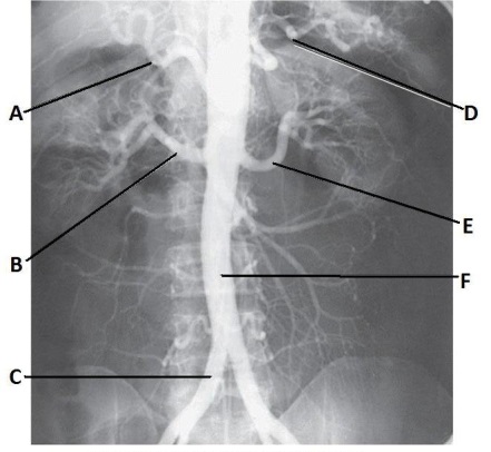 <strong>Letter B in the abdominal aortogram image below is the _____ artery. </strong> A) splenic B) celiac C) R renal D) hepatic