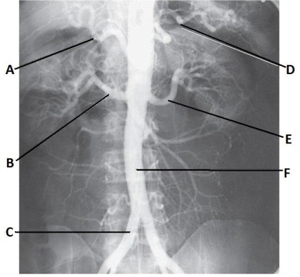 <strong>Letter C in the abdominal aortogram image below is the: </strong> A) R common iliac artery. B) abdominal aorta. C) R femoral artery. D) gonadal artery.