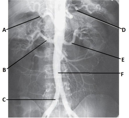 <strong>Letter E in the abdominal aortogram image below is the _____ artery. </strong> A) hepatic B) splenic C) L renal D) superior mesenteric