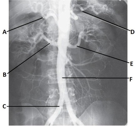 <strong>Letter F in the abdominal aortogram image below is the: </strong> A) abdominal aorta B) common iliac artery C) superior mesenteric artery D) inferior mesenteric artery