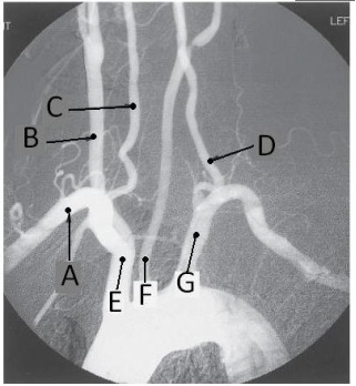 <strong>Letter A in the angiographic image of the aortic arch and its branches below is the _____ artery. </strong> A) innominate (brachiocephalic) B) R common carotid C) R subclavian D) R vertebral