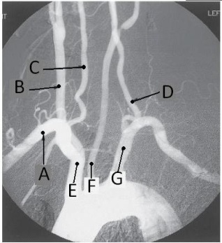 <strong>Letter B in the angiographic image of the aortic arch and its branches below is the _____ artery. </strong> A) innominate (brachiocephalic) B) R common carotid C) R subclavian D) R vertebral