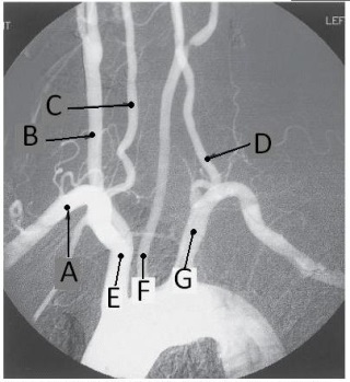 <strong>Letter C in the angiographic image of the aortic arch and its branches below is the _____ artery. </strong> A) innominate (brachiocephalic) B) R common carotid C) R subclavian D) R vertebral