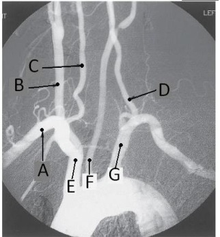 <strong>Letter D in the angiographic image of the aortic arch and its branches below is the _____ artery. </strong> A) innominate (brachiocephalic) B) L common carotid C) L subclavian D) L vertebral