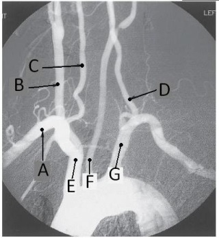 <strong>Letter E in the angiographic image of the aortic arch and its branches below is the _____ artery. </strong> A) innominate (brachiocephalic) B) L common carotid C) L subclavian D) L vertebral
