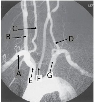 <strong>Letter F in the angiographic image of the aortic arch and its branches below is the _____ artery. </strong> A) innominate (brachiocephalic) B) L common carotid C) L subclavian D) L vertebral