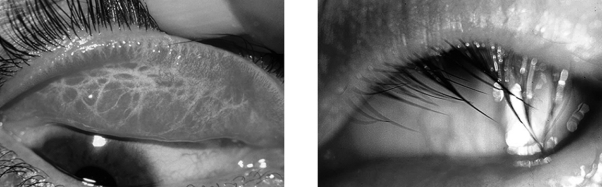While on a medical volunteer trip to an impoverished country, you encounter a patient whose eyelids are turned inward as shown. What is the cause and the best treatment?