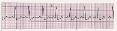 Identify the following rhythm: ____________________