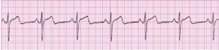 Identify the following rhythm (lead II): ____________________