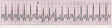 Identify the following rhythm (lead II): ____________________