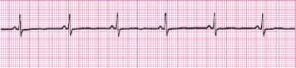 Identify the following rhythm (lead II): ____________________