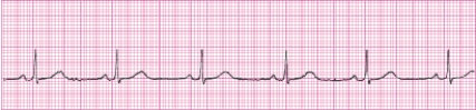 Identify the following rhythm (lead II): ____________________