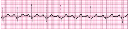 Identify the following rhythm (lead II): ____________________