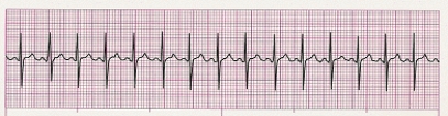 Identify the following rhythm (lead I): ____________________