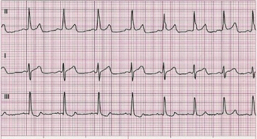 Identify the following rhythm: ____________________
