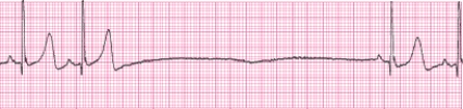 Identify the following rhythm (lead II): ____________________