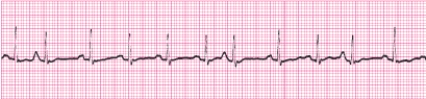 <strong>Identify the following rhythm (lead II). </strong> A) Atrial fibrillation B) Sinus arrhythmia C) Multifocal atrial tachycardia D) Sinus tachycardia with premature atrial complexes (PACs)