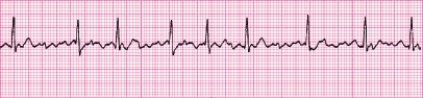 <strong>P waves in this rhythm strip _____. </strong> A) are upright before every QRS complex B) are inverted before every QRS complex C) vary in size and shape D) are not identifiable