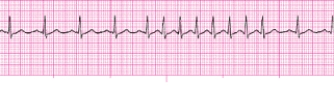 <strong>Identify the following rhythm (lead II). </strong> A) Sinus arrhythmia B) Atrial tachycardia C) Multifocal atrial tachycardia with a PAC D) Sinus rhythm with a PAC,a run of PSVT,back to a sinus rhythm