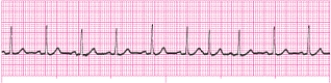 <strong>Identify the following rhythm (lead II). </strong> A) Sinus arrhythmia B) Sinus tachycardia C) Sinus rhythm with a PAC D) Sinus tachycardia with a PAC