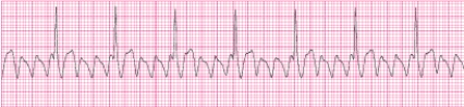 <strong>Identify the following rhythm (lead II). </strong> A) Atrial flutter B) Atrial fibrillation C) Wolff-Parkinson-White syndrome D) AV nodal reentrant tachycardia (AVNRT)